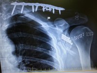 Oct 2017_shoulder surgery (4).jpg